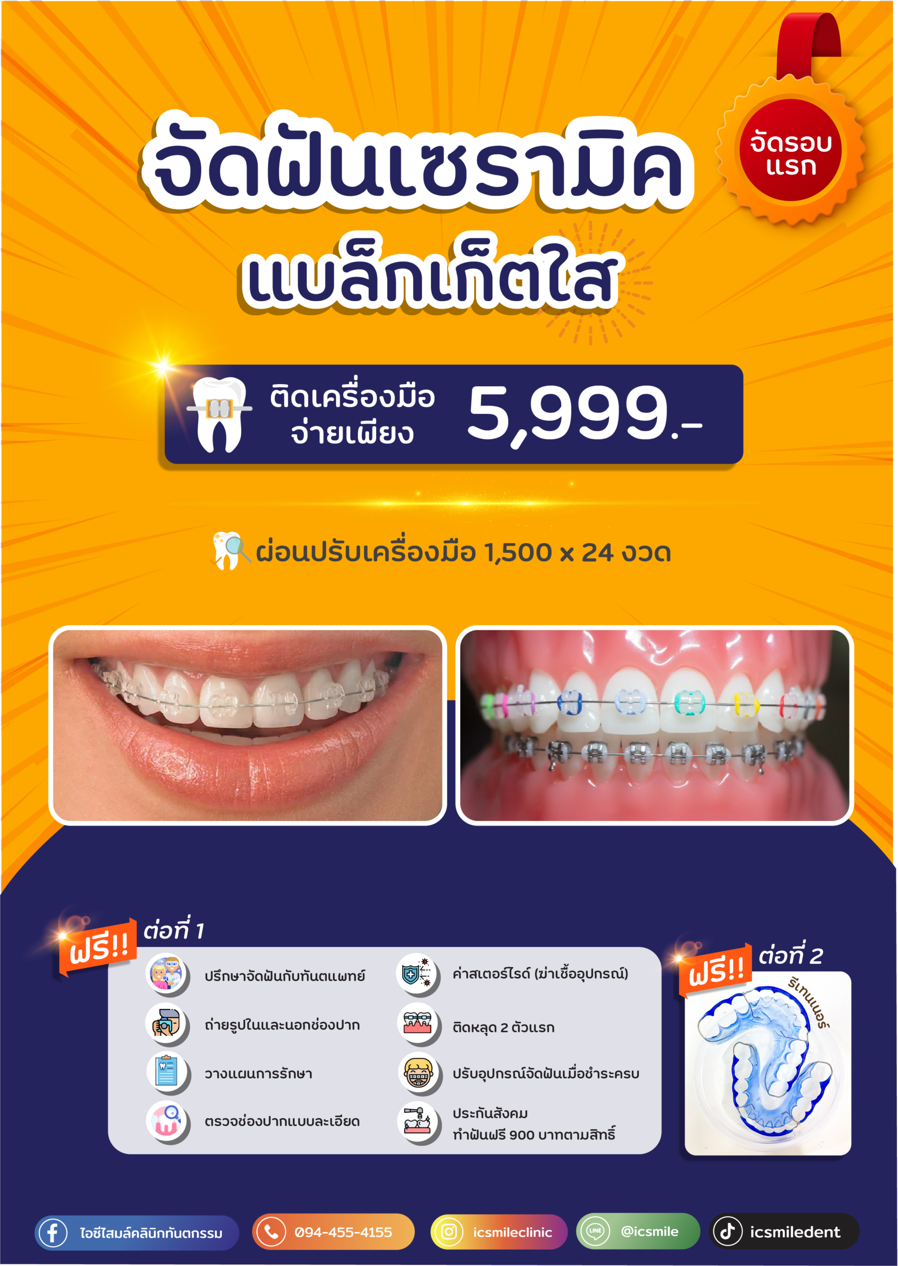 จัดฟันเซรามิค